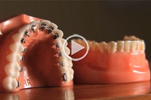 Braces are More Attractive than Crooked Teeth Video Thumbnail at MK Orthodontics in Waterville and Augusta ME