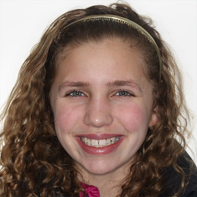Teen smiling with mild crowding and uneven front tooth alignment before orthodontic treatment.