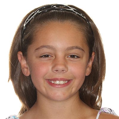 Young girl smiling with slight spacing and developing tooth alignment before orthodontic treatment.