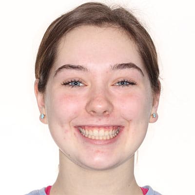 Teen smiling after treatment with straight, evenly aligned teeth and a wider, more balanced smile.