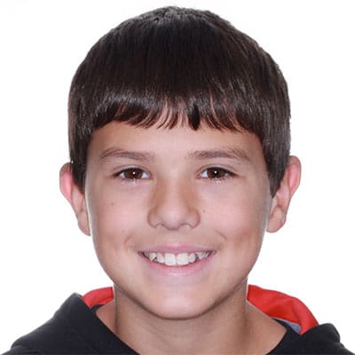 Smiling child with slight crowding and developing tooth alignment before orthodontic treatment.