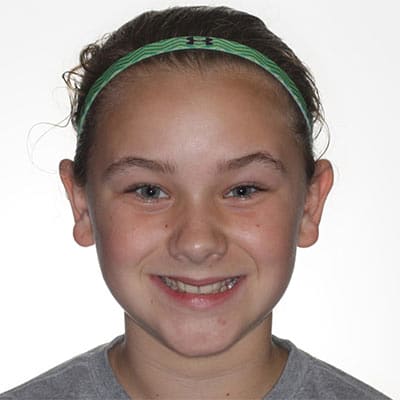 Smiling child with mild tooth crowding and uneven front teeth before smile alignment treatment.