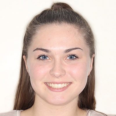 Patient after orthodontic treatment with a straighter, healthier smile