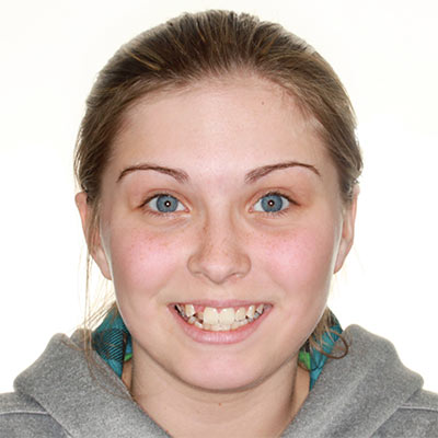 Patient before orthodontic treatment showing smile alignment prior to treatment